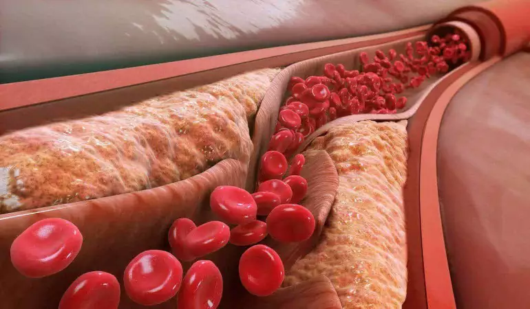 Scientists discover innovative treatment for high cholesterol